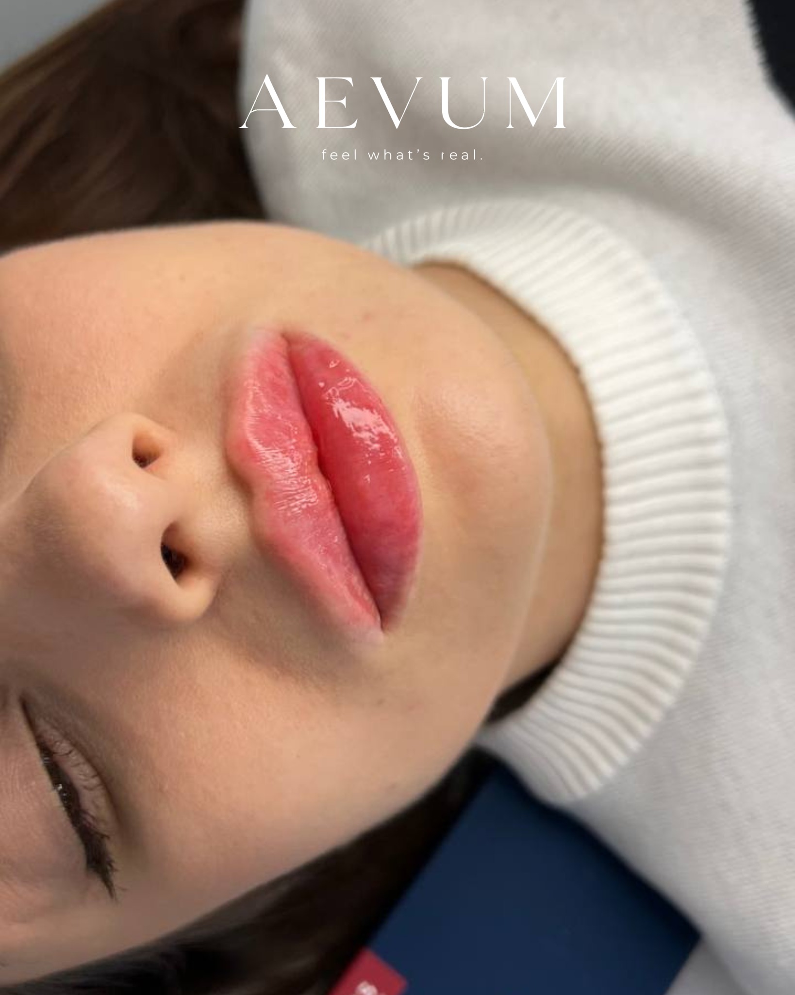 Skin Quality Protocol — post biostimolazione
